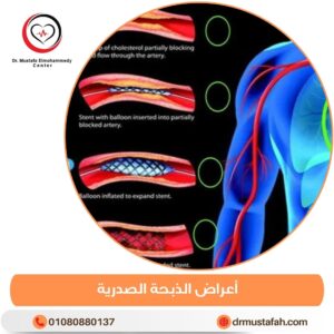 أعراض الذبحة الصدرية