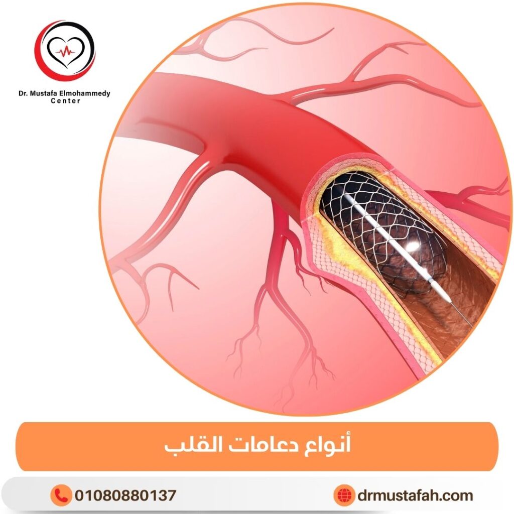 أنواع دعامات القلب ونصائح قبل تركيبها 