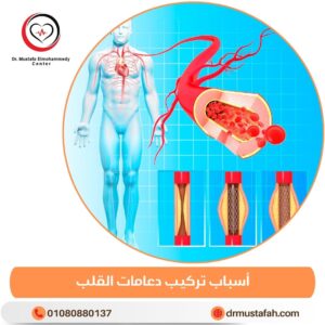 أسباب تركيب دعامات القلب