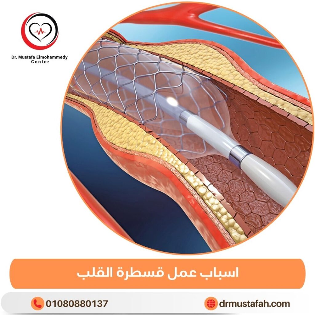 اسباب عمل قسطرة القلب