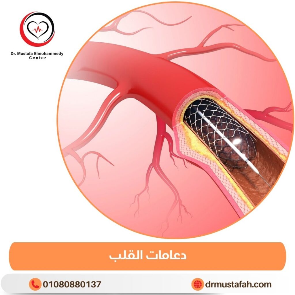 دعامات القلب