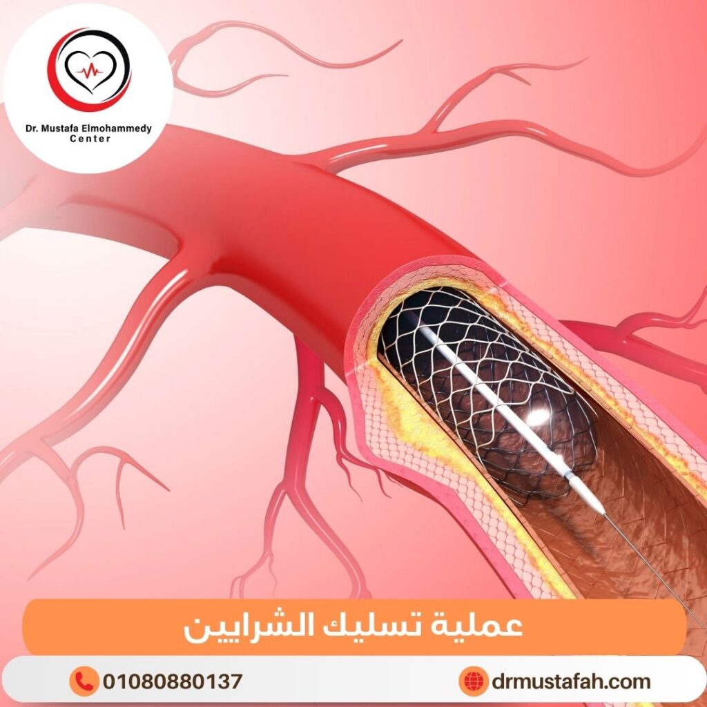 عملية تسليك الشرايين