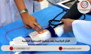 الآثار الجانبية بعد عملية القسطرة القلبية