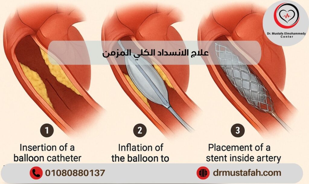 علاج الانسداد الكلي المزمن