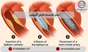 علاج الانسداد الكلي المزمن بأحدث الطرق الطبية الحديثة 01000969782 1 علاج الانسداد الكلي المزمن